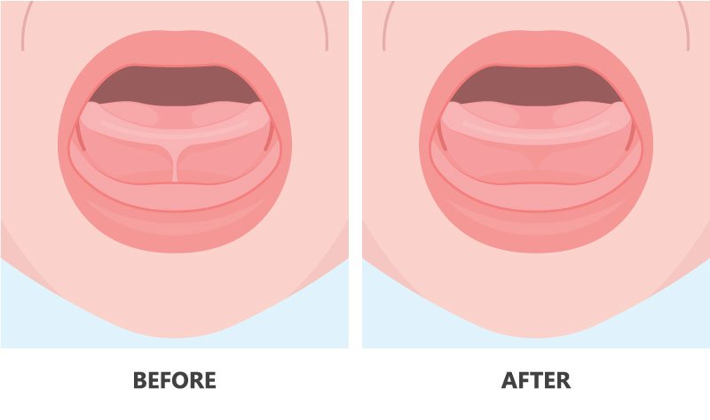 Issaquah Tongue-tie Surgery